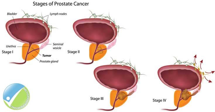 Are there different stages of prostate cancer