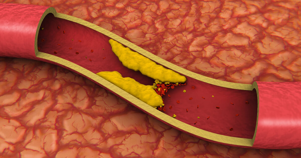 ateroscleroză placă aterom colesterol LDL HDL risc cardiovascular infarct miocardic acut accident vascular cerebral