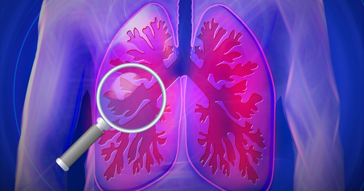 grafic plaman lupa fibroza pulmonara idiopatica