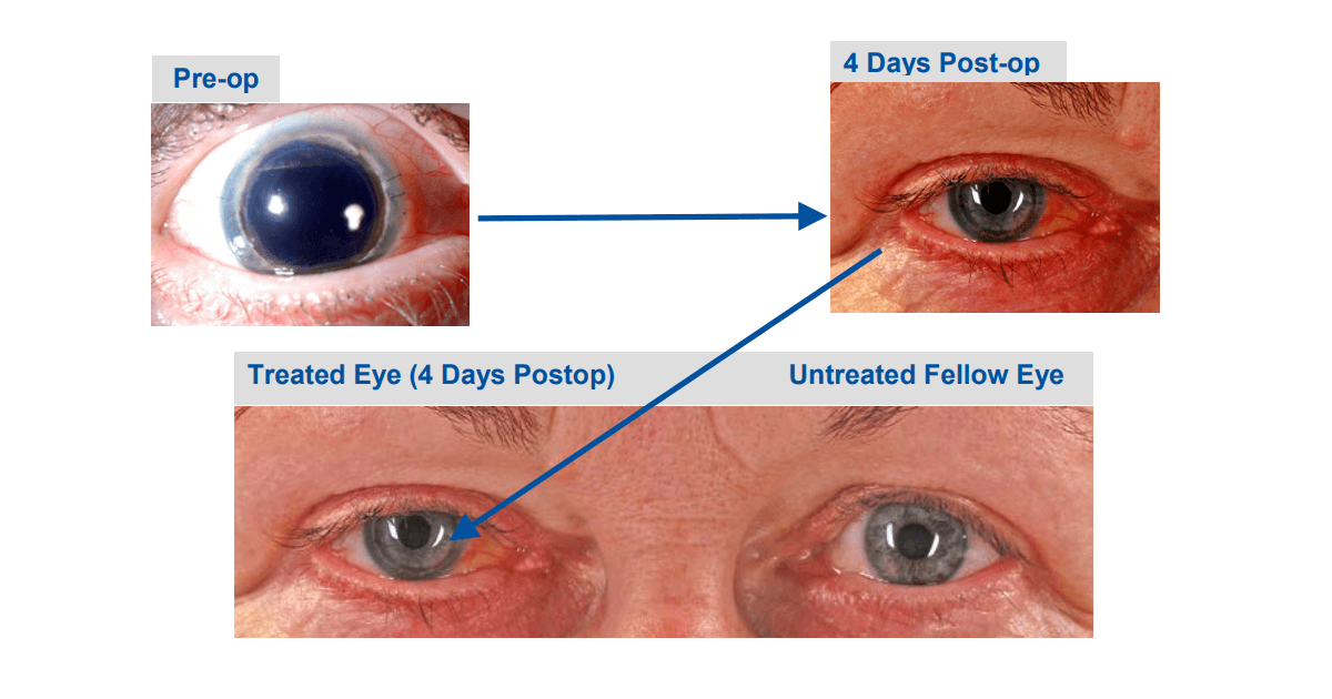 Primul iris artificial pentru adulți și copii, CustomFlex, a fost