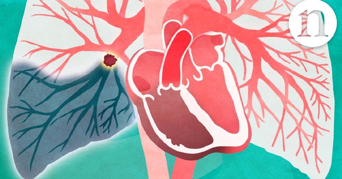 tromboembolism pulmonar imagine feature