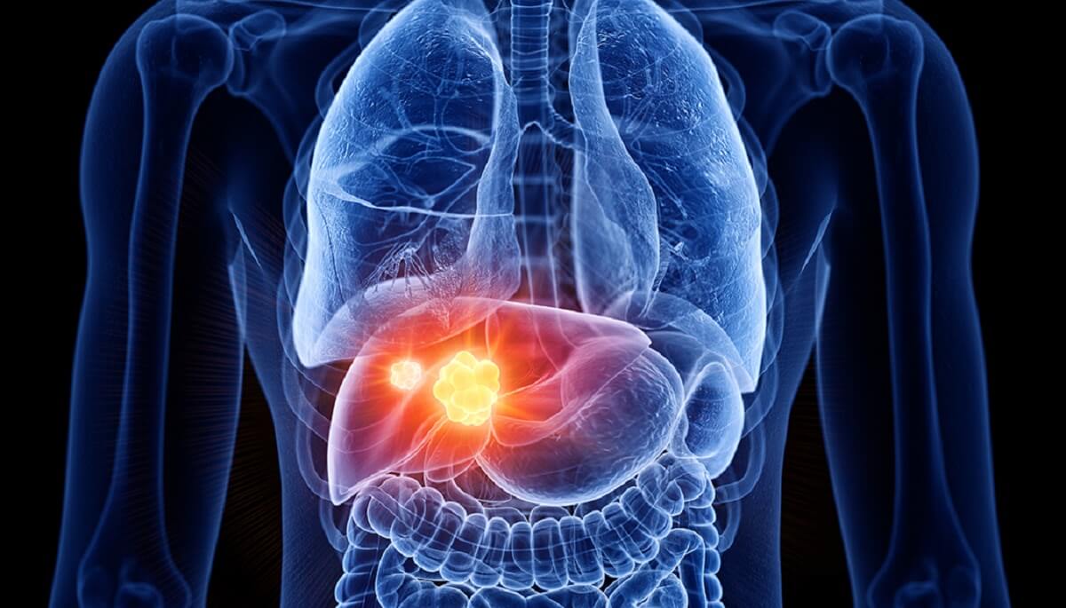 Combinația atezolizumab și bevacizumab crește supraviețuirea generală și supraviețuirea fără progresie a bolii în carcinomul hepatocelular nerezecabil