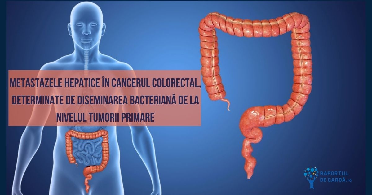 Afectarea barierei vasculare intestinale determină metastazare hepatică în cancerul colorectal