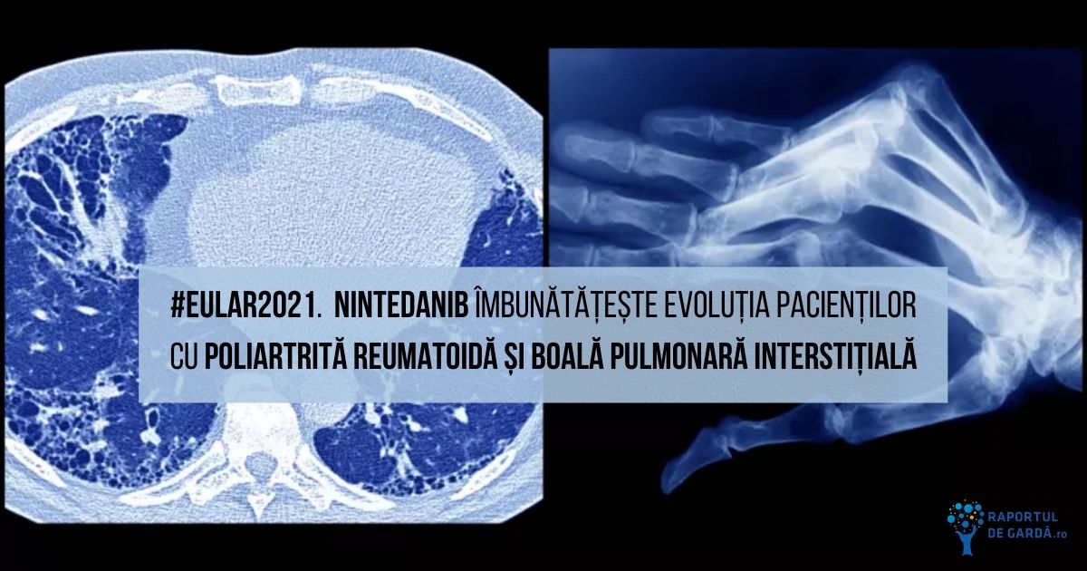 #EULAR2021 Nintedanib poliartrita reumatoida boala pulmonara interstitiala