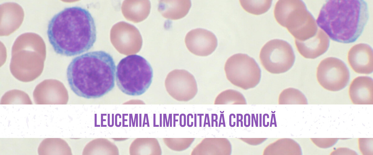 FAQ Leucemia Limfocitară Cronică