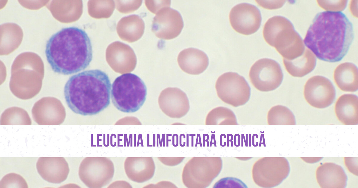 Întrebări despre leucemia limfocitară cronică