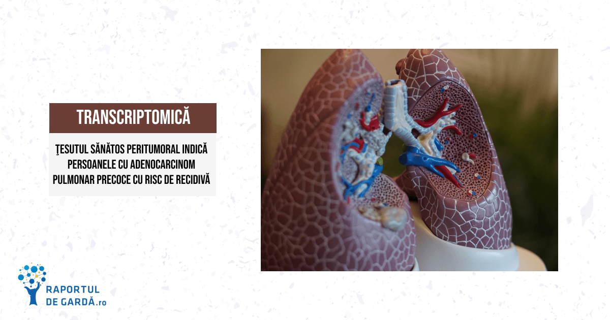 STUDIU. Expresia genică la nivelul țesutului sănătos peritumoral poate indica pacienții cu adenocarcinom pulmonar precoce care vor avea recidive în urma tratamentului chirurgical