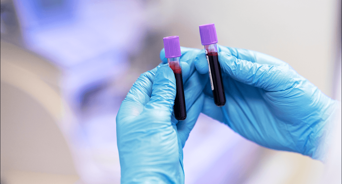 sange pentru testare kras in cancerul pancreatic