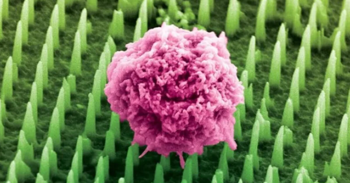 Plasture cu nanoace, o alternativă eficientă, real-time și non-invazivă a biopsiei tradiționale
